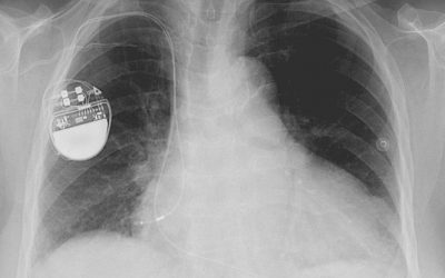 Pacemaker Implantation Procedure